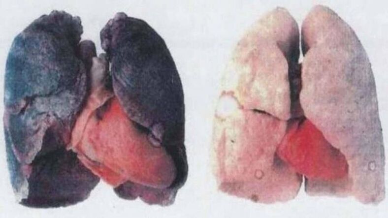 Daudzi hroniski alkoholiķi mirst plaušu bojājumu dēļ (pa kreisi)