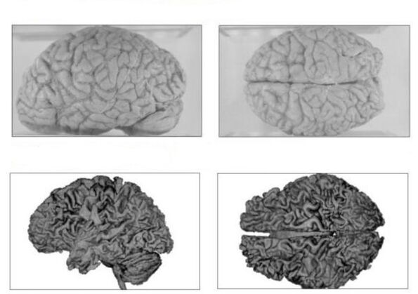 Vesela cilvēka smadzenes (augšā) un alkoholiķa smadzenes ar neatgriezeniskām sekām (apakšā)